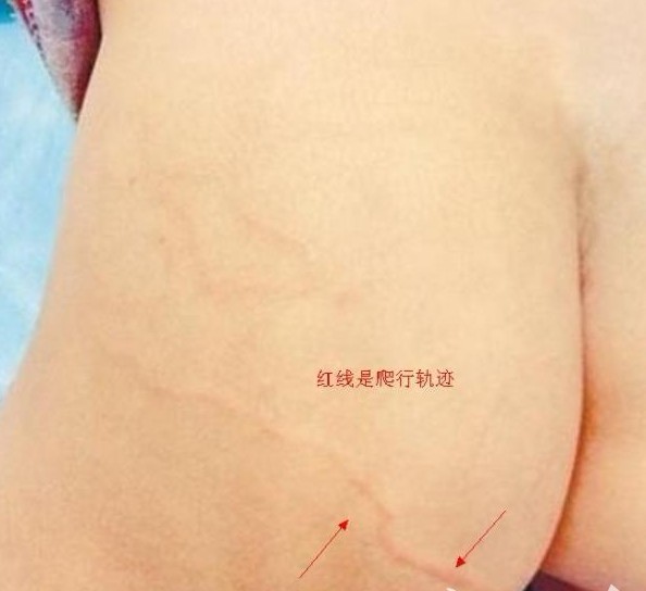 人皮蝇幼虫图片图片_幼虫孵化出来会钻进人的皮
