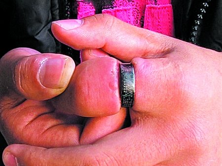 黔江高中生<em>食指戴戒指</em>肿成萝卜