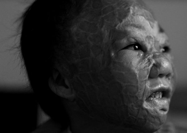 小文文首期手术成功!将面临<em>头发再生</em>及面部整