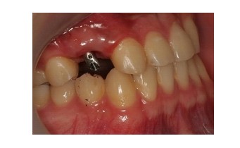 种植牙_网上逛街_来凤百姓网